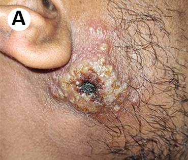 Clinical presentation of monkeypox - Primary inoculation site with large pustule of the skin of the right lower face