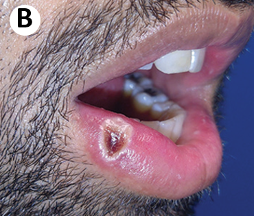 Clinical presentation of monkeypox - B. A pustular lesion with a crusted centre on the right lower lip.