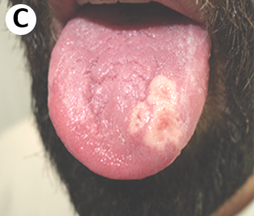 Clinial presentation of monkeypox - C. Three confluent lesions of the left dorsal tongue