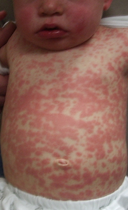 The measles rash usually begins as flat red spots that appear on the face at the hairline and spread downward to the neck, trunk, arms, legs, and feet. Small raised bumps may also appear on top of the flat red spots. The spots may become joined together as they spread from the head to the rest of the body.