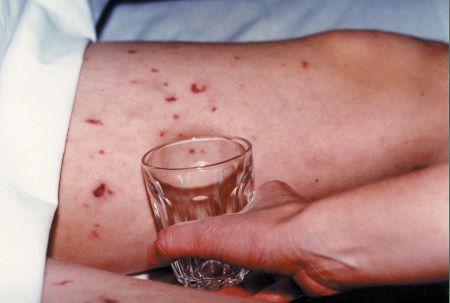 A leg with a red-purple rash. A glass is being pressed against it, and the rash has not faded compared with surrounding skin not under the glass.