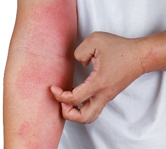 A person scratching a rash on their arm.