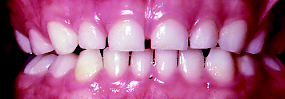 Photo of childs teeth and gums with healthy pink gums and white teeth with no discolouration