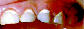 Photo of child's teeth and gums showing white lines on the teeth along the gumline