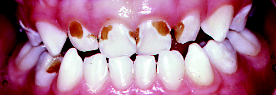 Photo of childs teeth and gums showing large brown spots on 4 upper teeth and 1 lower tooth