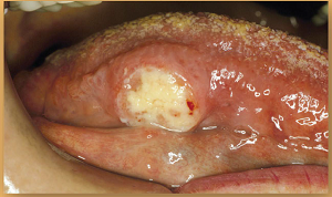 Photo showing mouth with tongue cancer