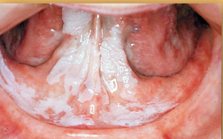 Photo of area under the tongue exhibiting white patchy areas