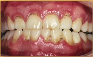 Photo of teeth and gums showing red unhealthy gums and teeth with brown stains at the gumline
