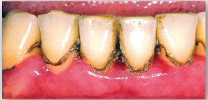 Photo of lower teeth with brown stains on teeth around the gumline