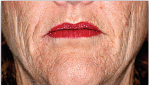 Photo of lower half of woman's face showing premature wrinkled skin on face and around lips.